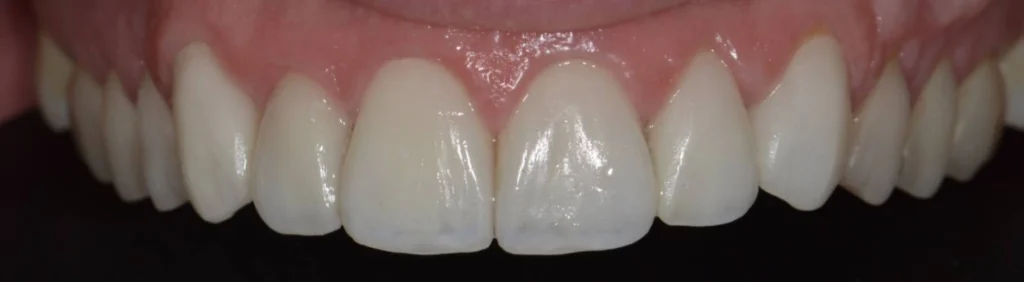 facettes dentaires paris 3 4