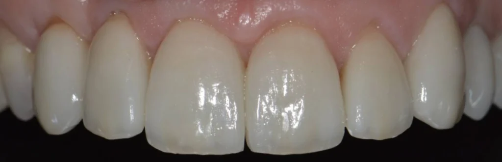 facettes dentaires paris 4