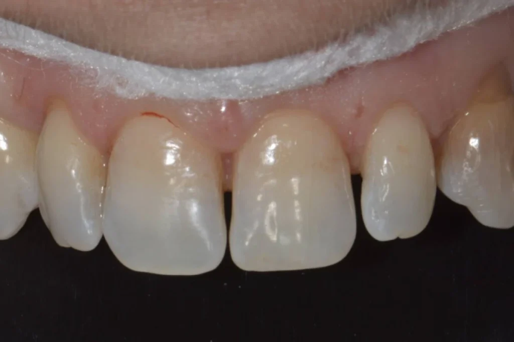 facettes dentaires paris 5