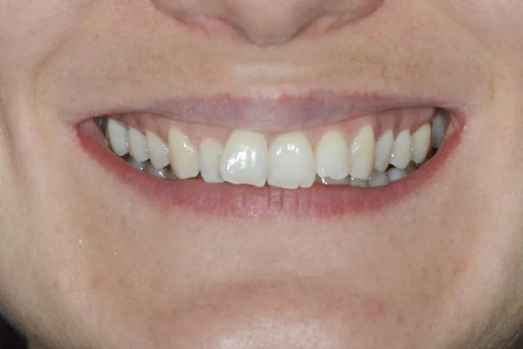 gouttieres transparentes paris