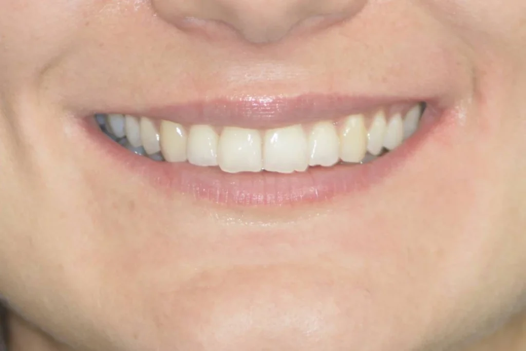 gouttieres transparentes paris 3