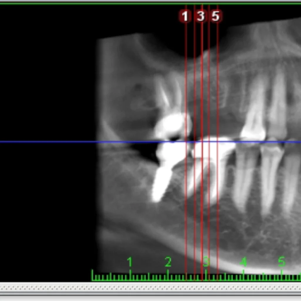 greffe osseuse paris 1