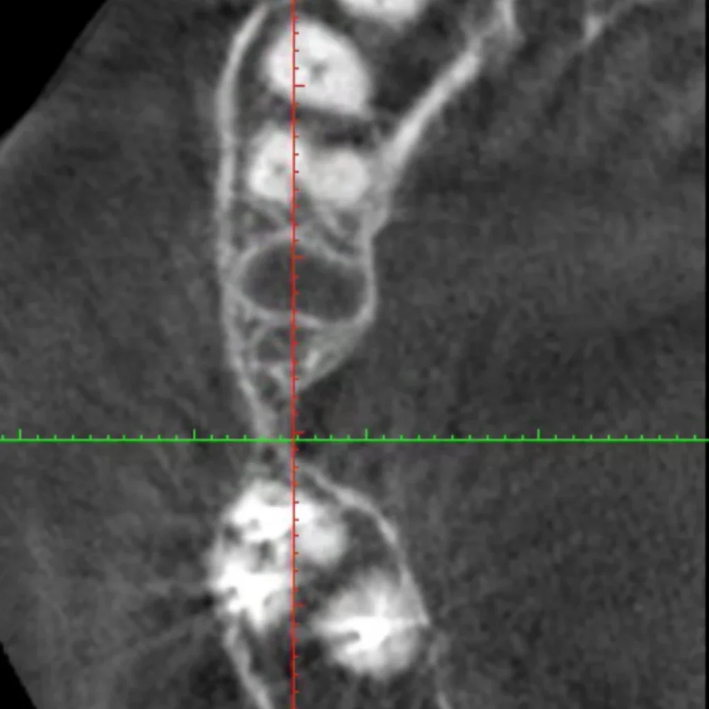 greffe osseuse paris 1 2