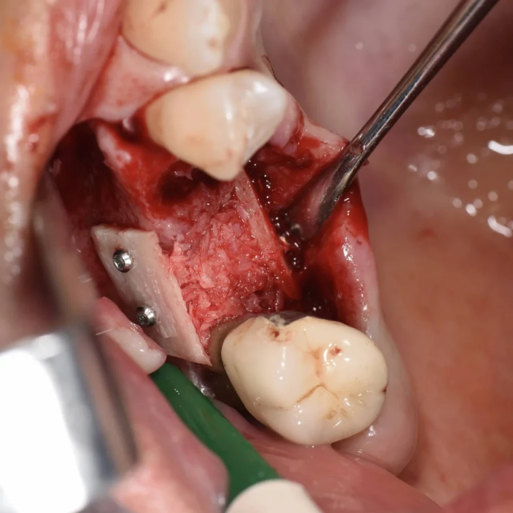 greffe osseuse paris 1 3