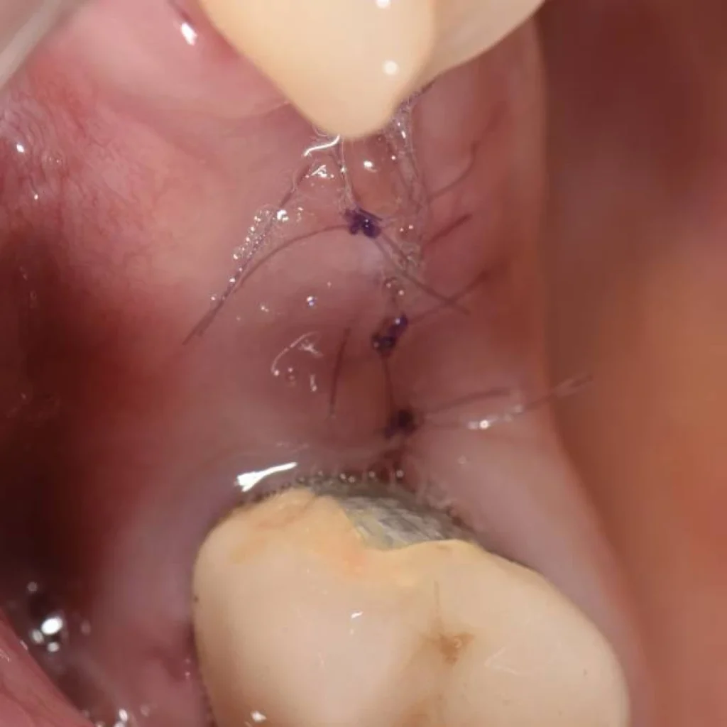 greffe osseuse paris 1 4