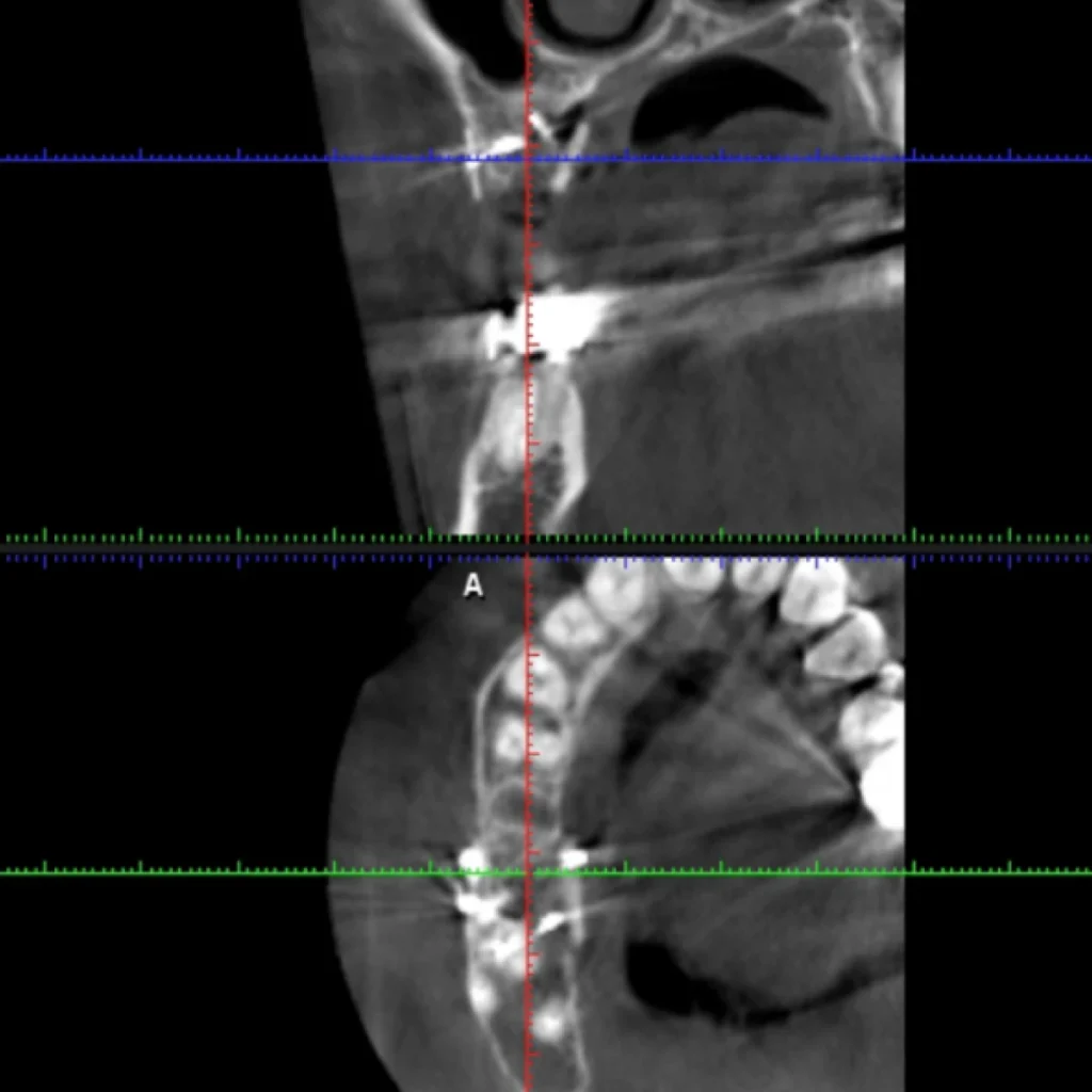 greffe osseuse paris 1 5