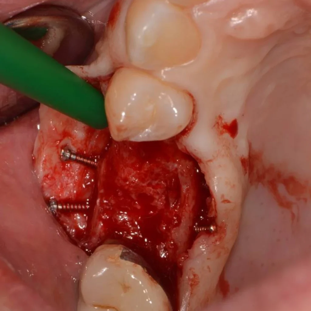 greffe osseuse paris 1 6