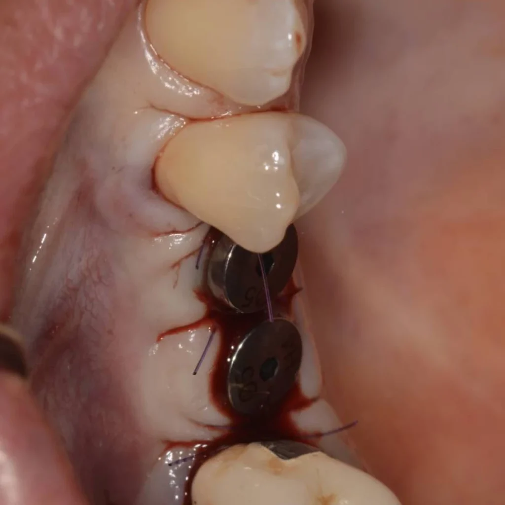 greffe osseuse paris 1 7