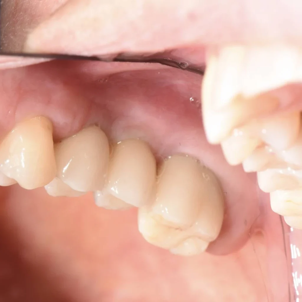 greffe osseuse paris 1 8