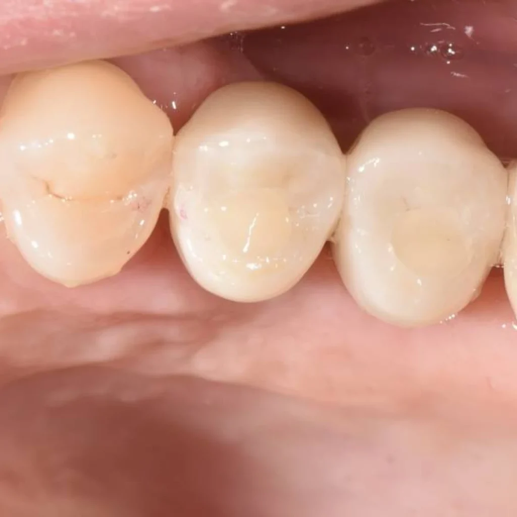 greffe osseuse paris 1 9