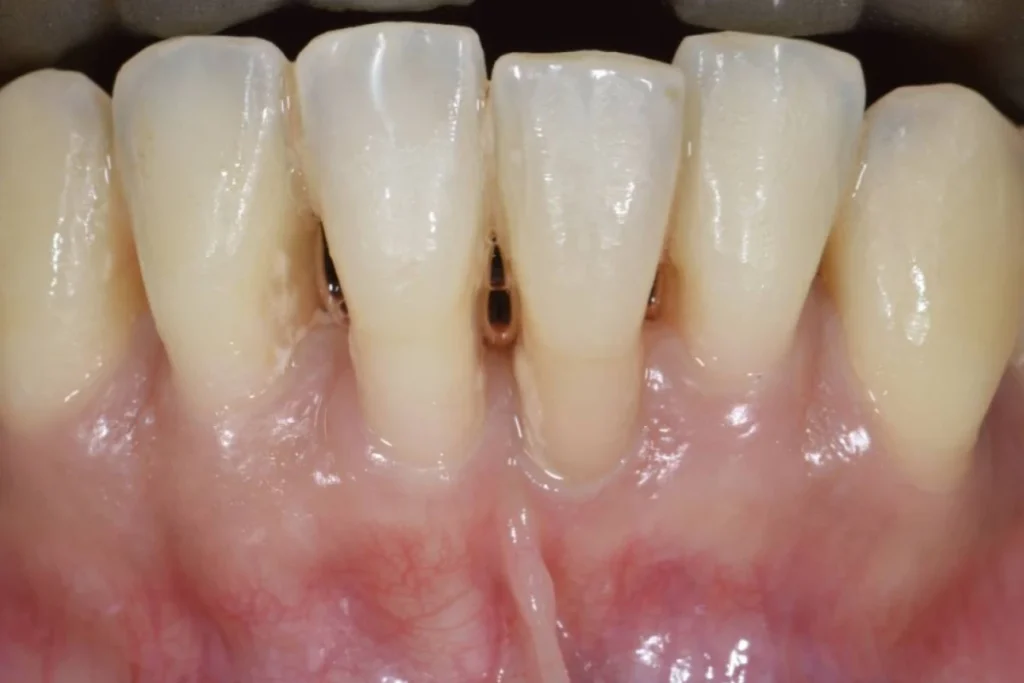 greffes gencive paris 1 (1)