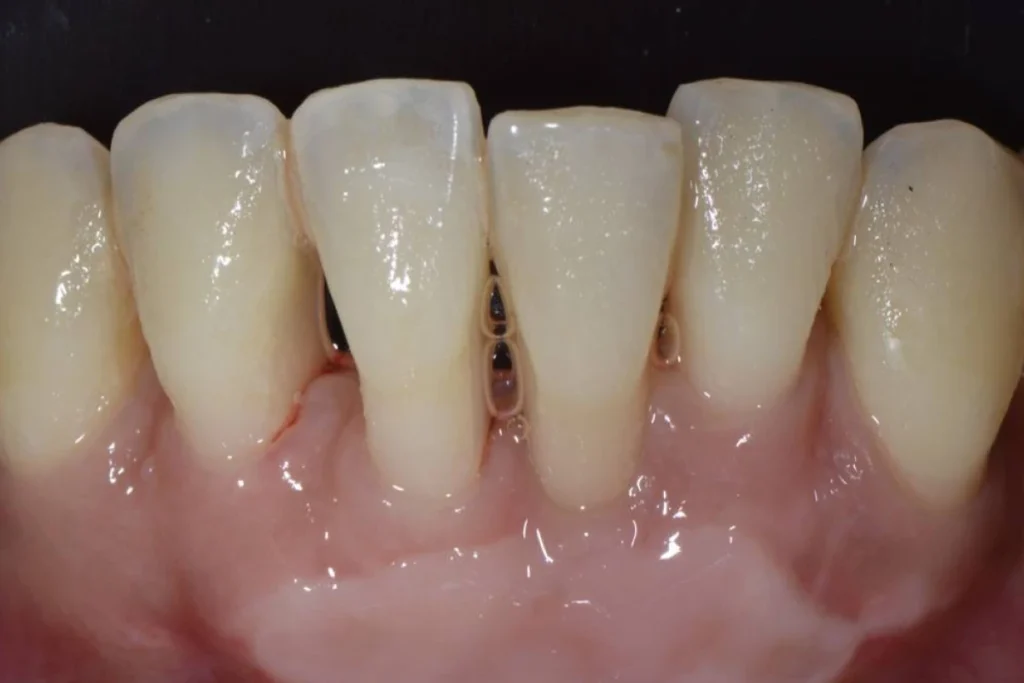 greffes gencive paris 2