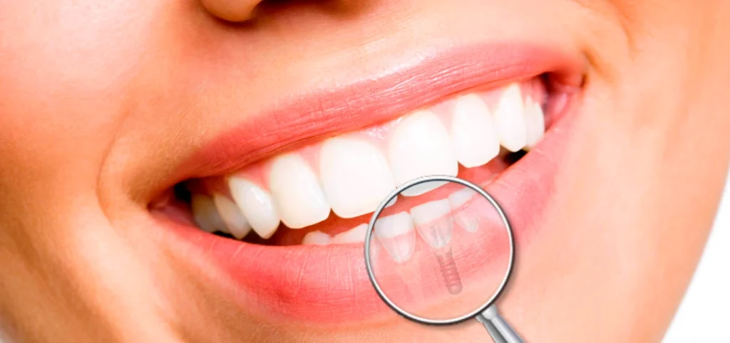 implant dentaire paris