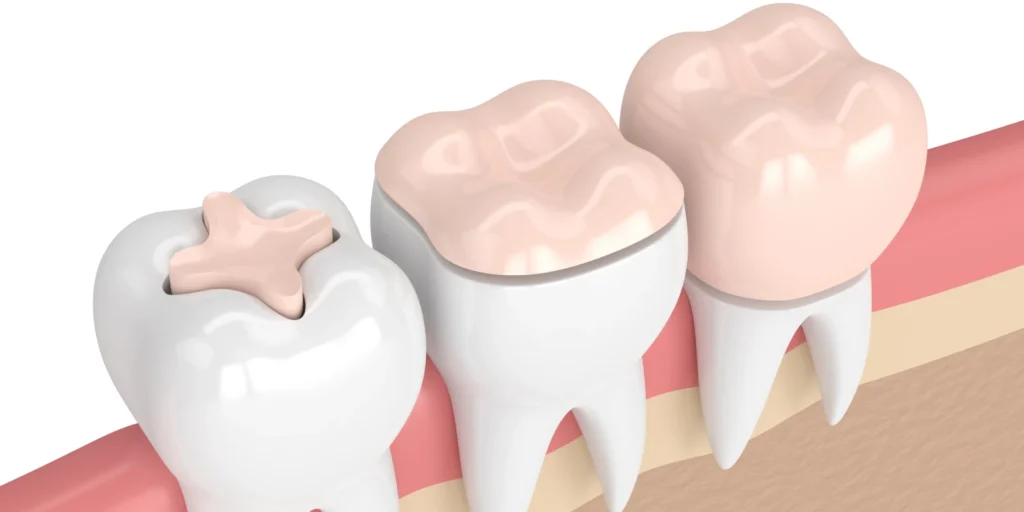 inlay onlay dentiste paris