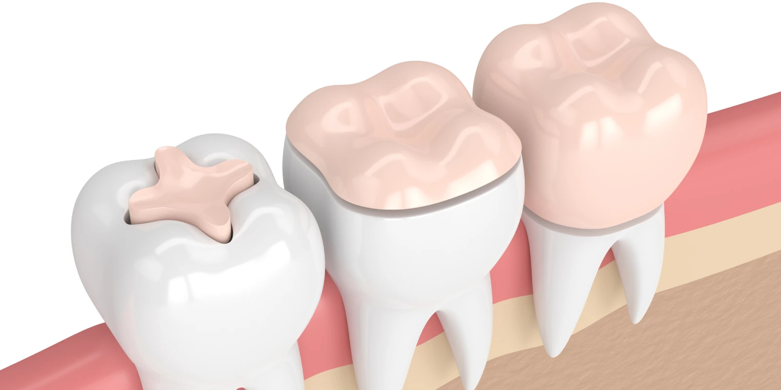 inlay onlay dentiste paris