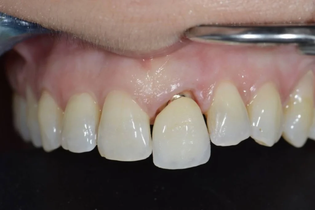 remplacement couronne paris