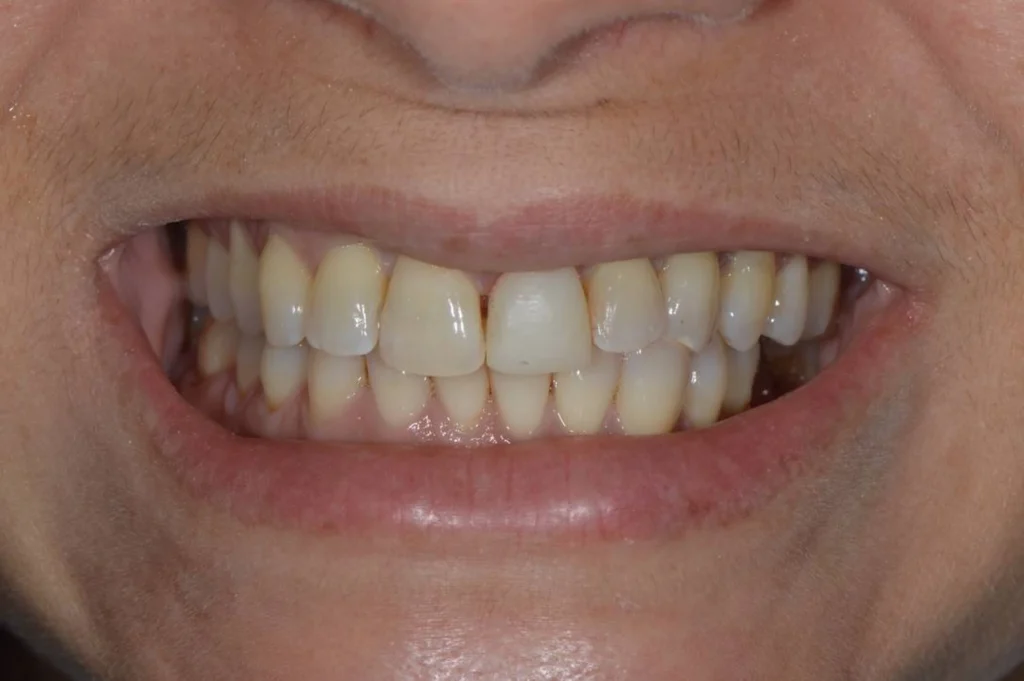 remplacement couronne paris 2