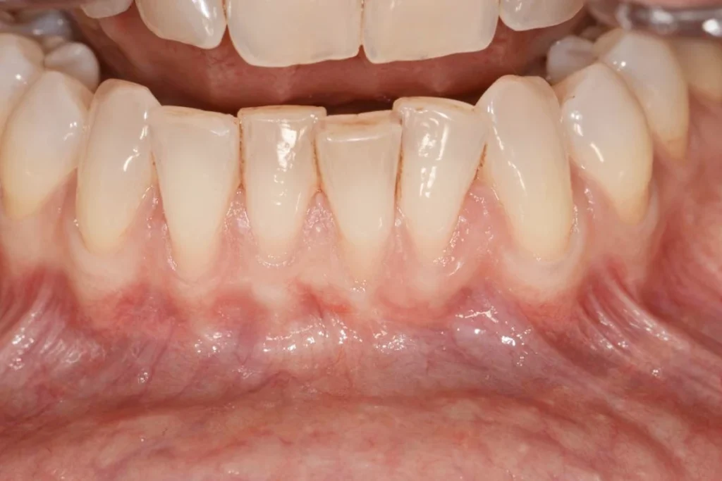 soin gencives paris 1