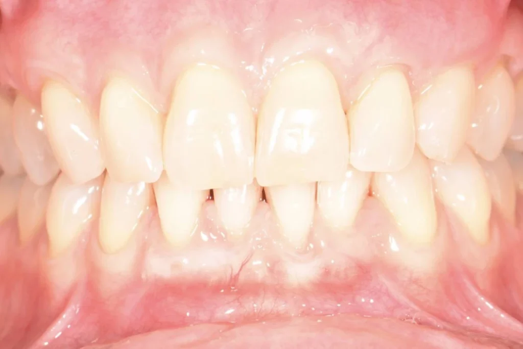 soin gencives paris 4