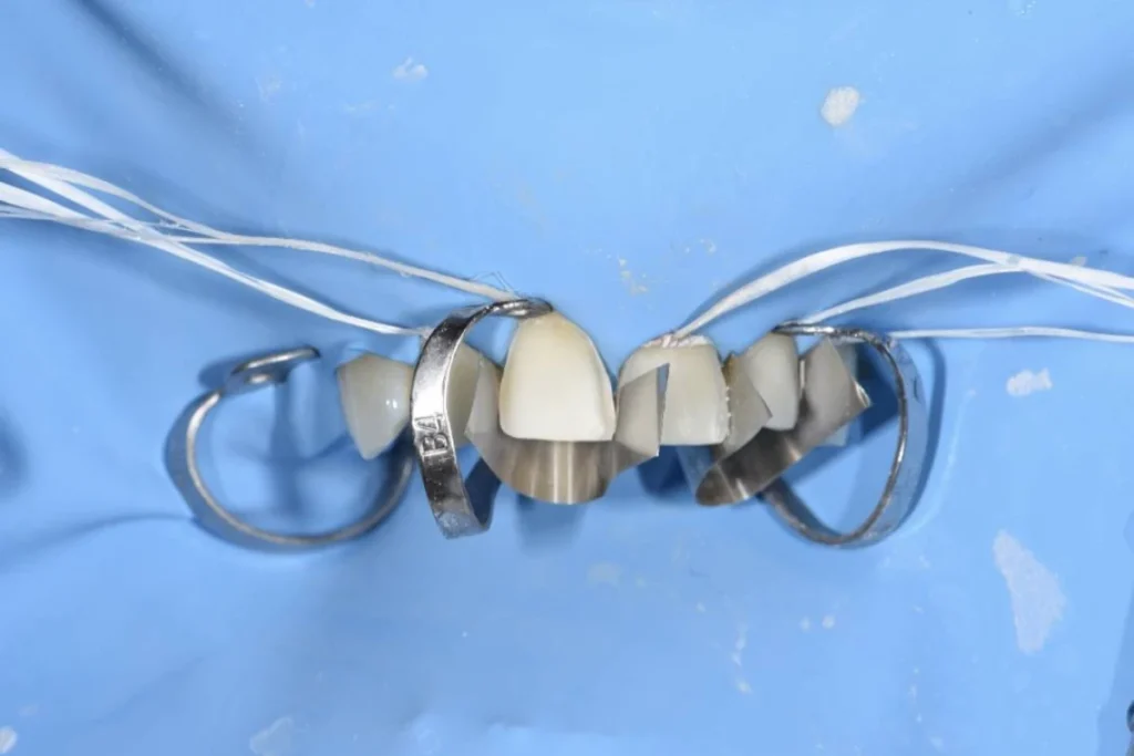 usure dentaire facettes ceramique paris